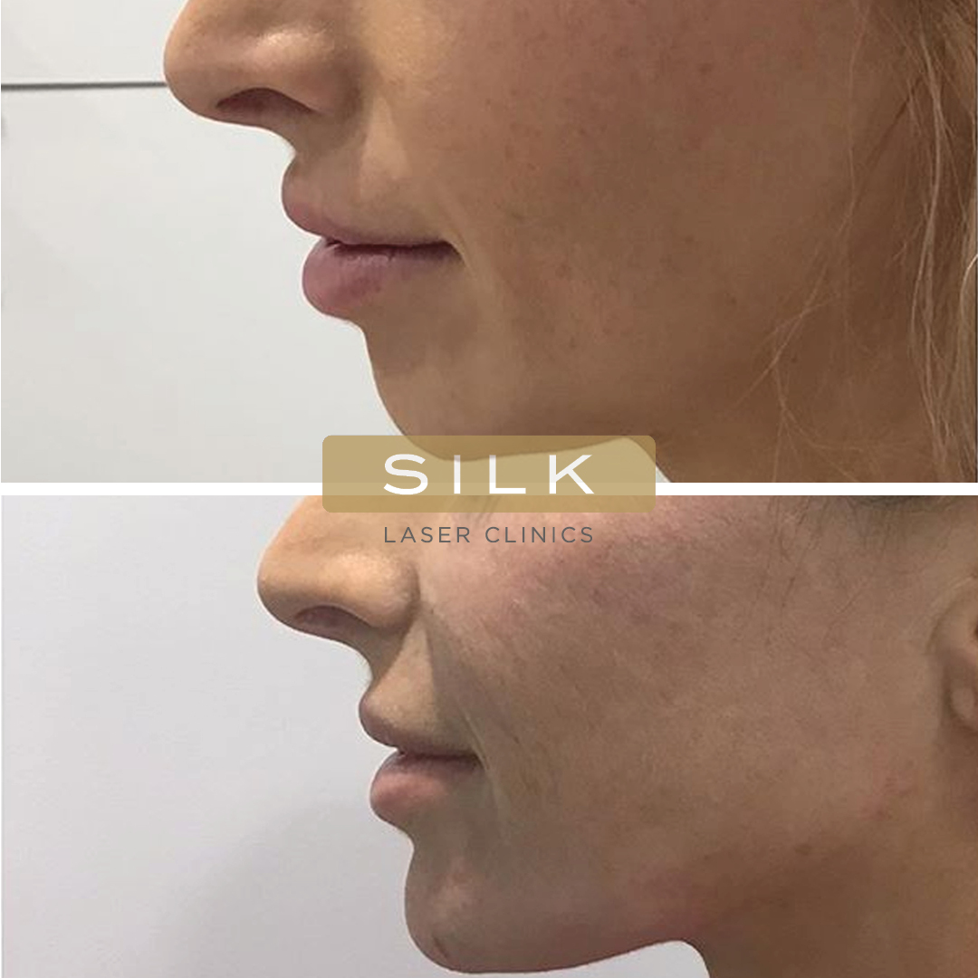 Jawline filler: Everything you need to know! - SILK Laser Clinics