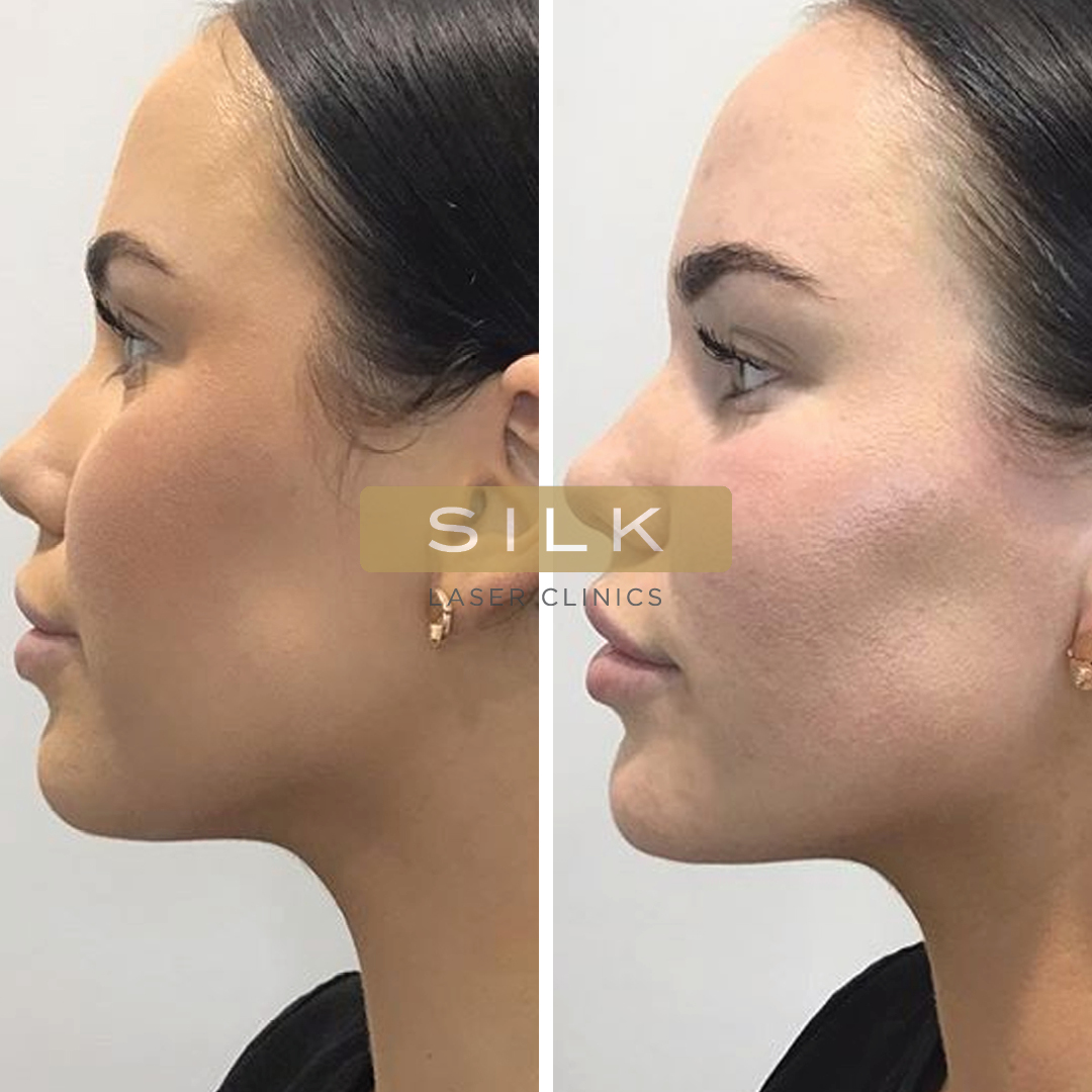 Face Contouring for Younger Patients: Improving the Jawline and