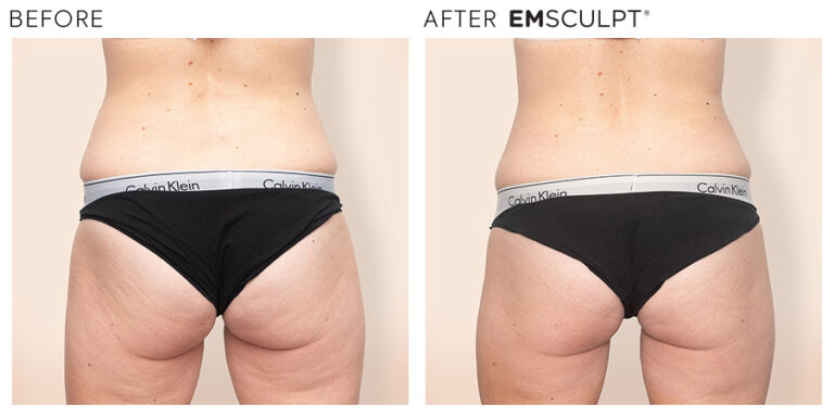 Emsculpt Non Invasive Butt Lift Silk Laser Clinics