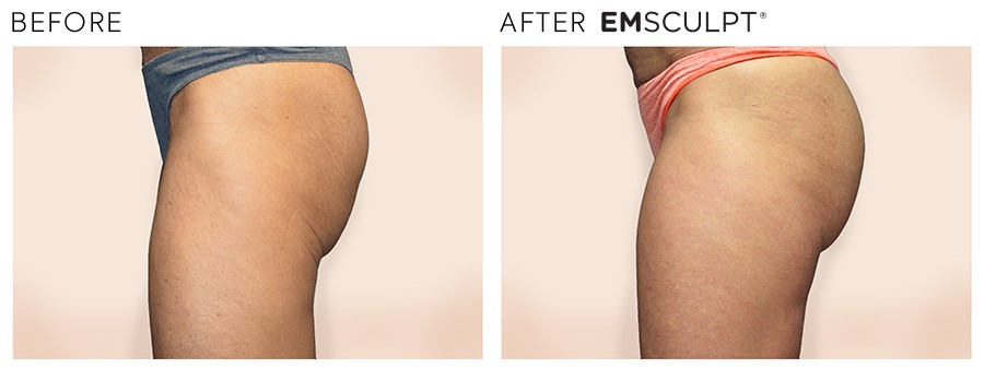 EmSculpt Non-Invasive Butt Lift - SILK Laser Clinics