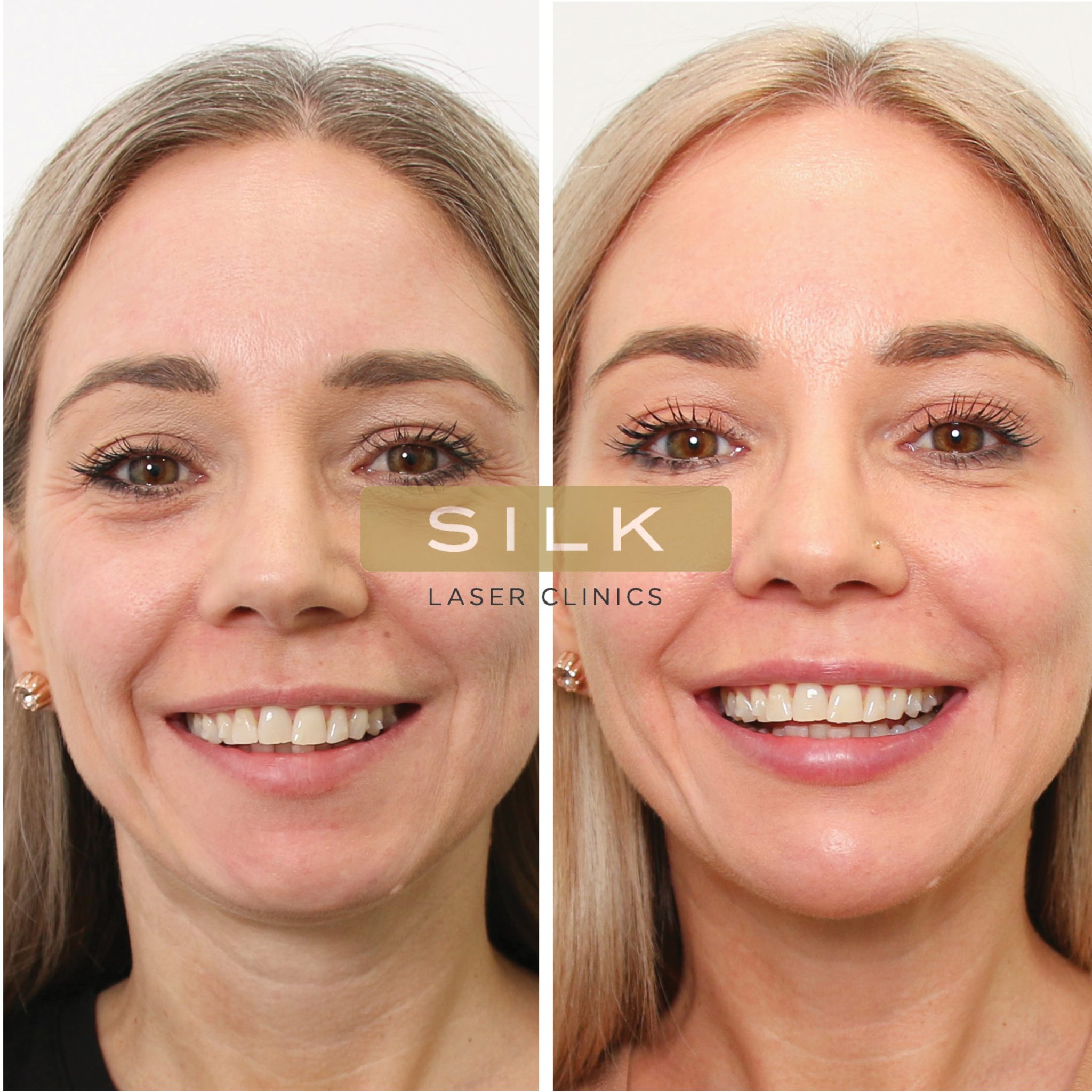 SILK Laser Clinics Skin Treatments & Laser Clinics