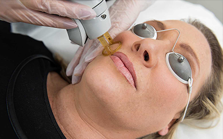 Add On Laser Pigment Removal - Decolletage Featured Image