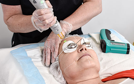 Laser-Redness-Removal