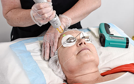Laser-Vascular-Treatment