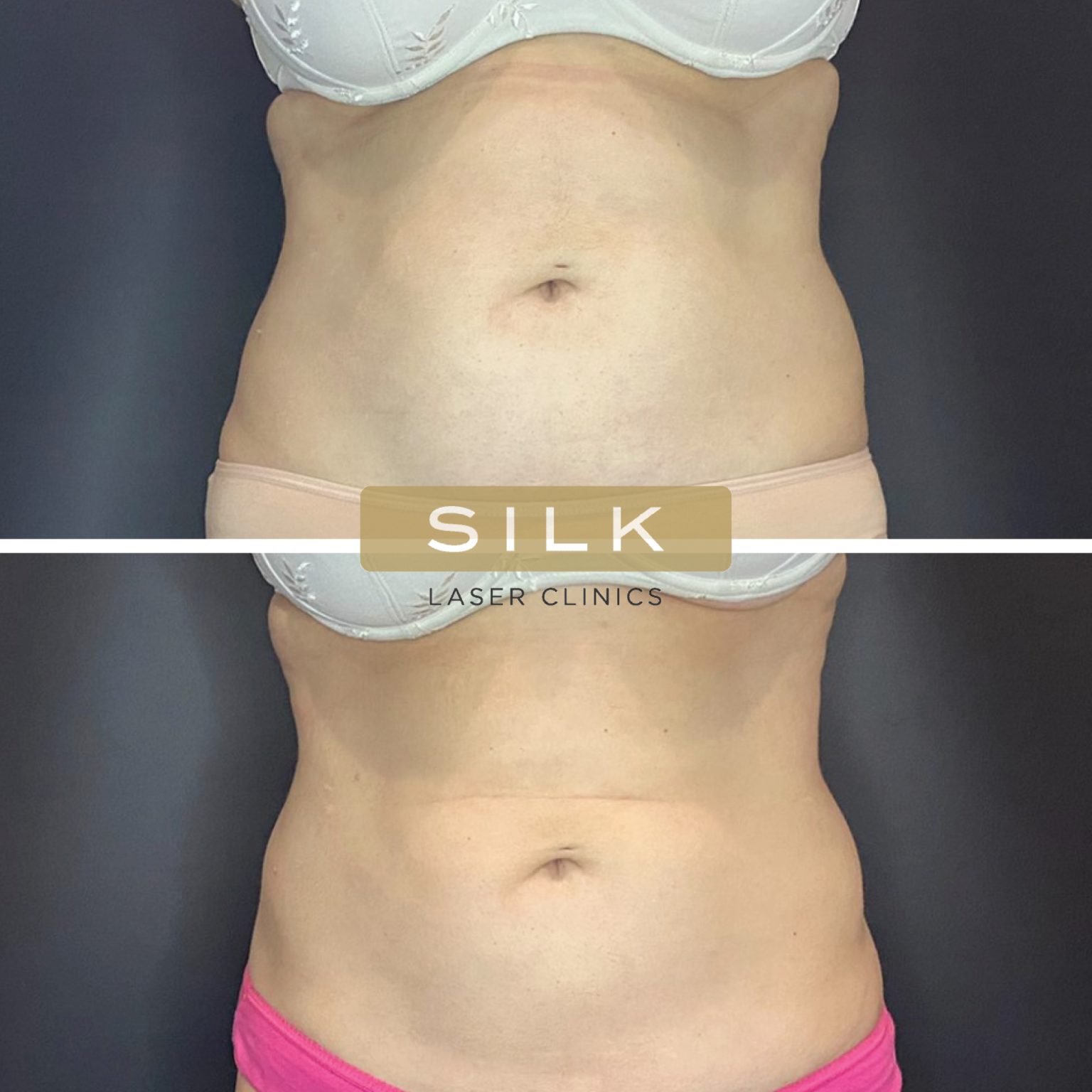 Coolsculpting Body Sculpting Silk Laser Clinics