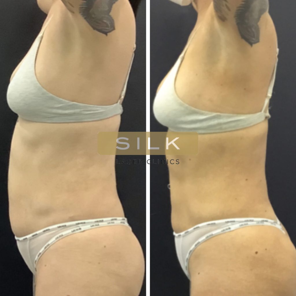 EMBODY™ AB SCULPT  Body Sculpting Clinics