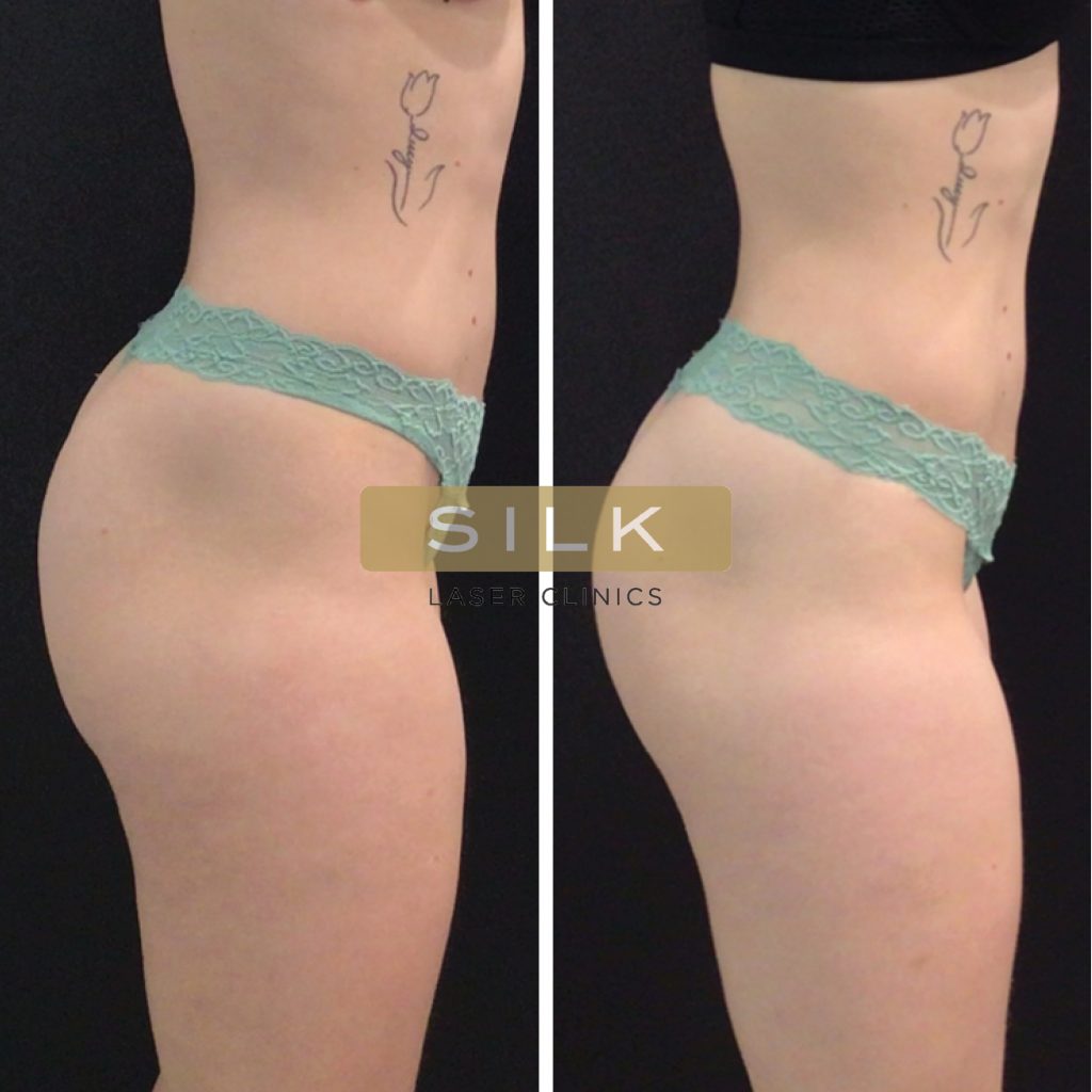 EMBODY™ BUTT SCULPT  Body Sculpting Clinics