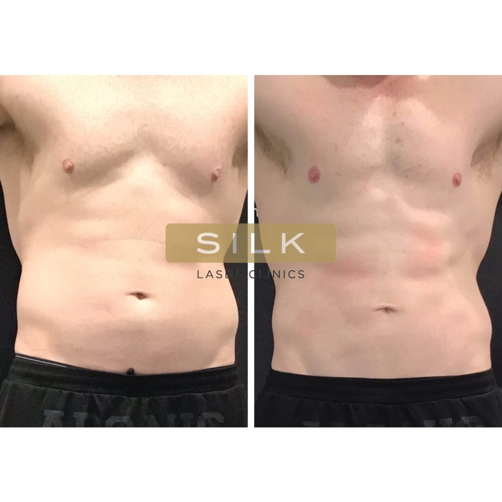 Treating Diastasis Recti - without surgery. - SILK Laser Clinics