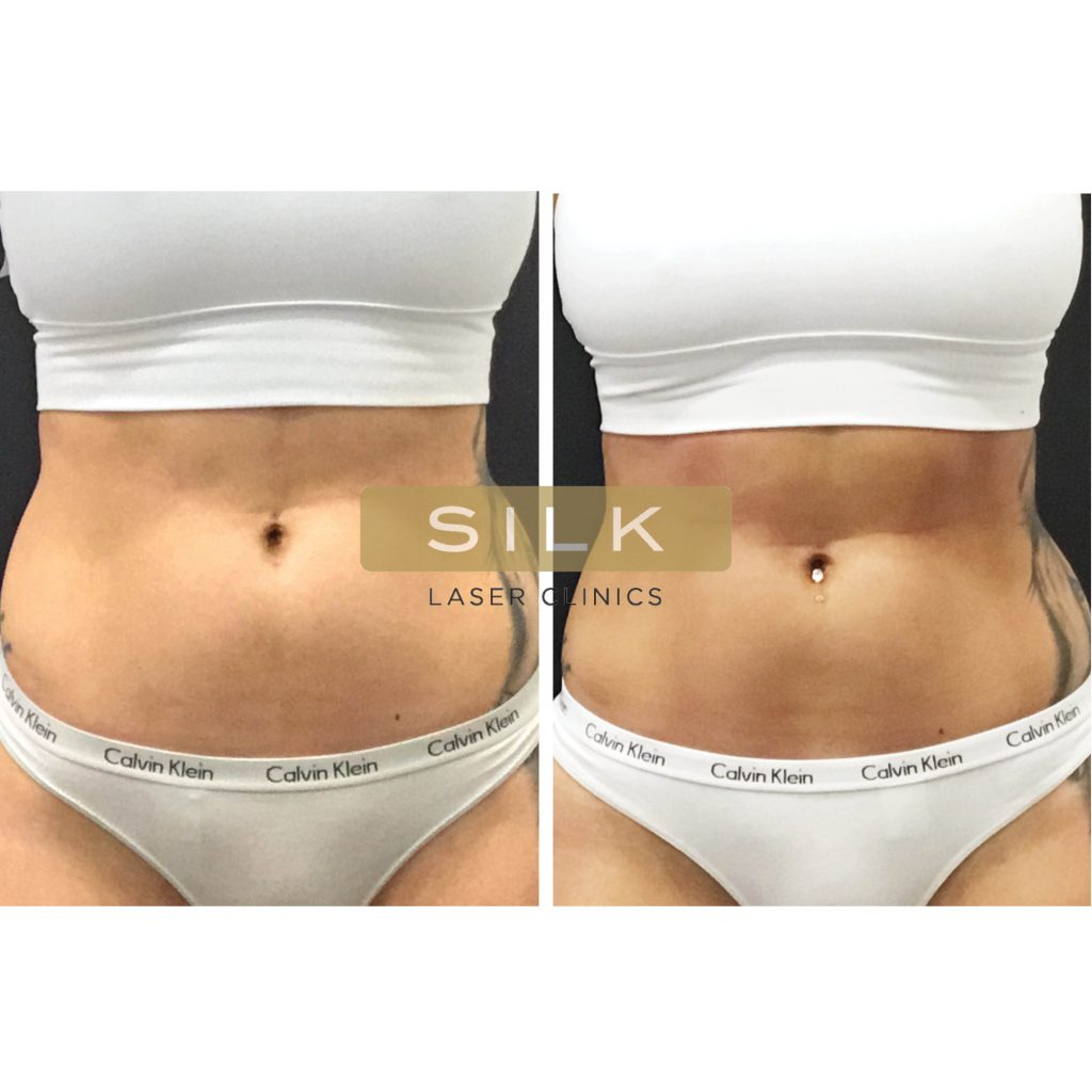 EMBODY™ BUTT SCULPT  Body Sculpting Clinics