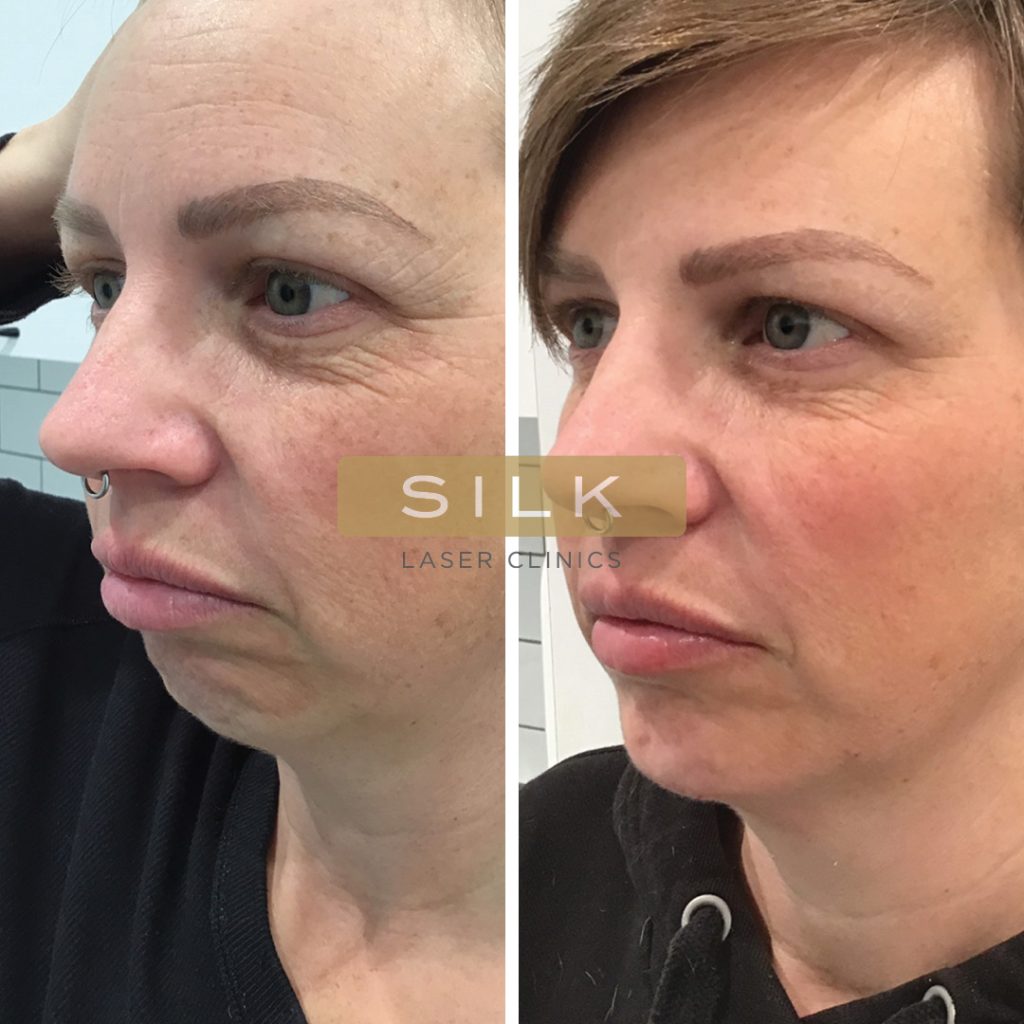 Anti Wrinkle Injections Treatment - SILK Laser Clinics