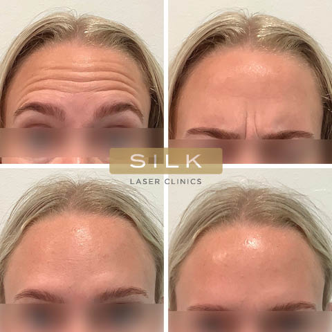 Before After Results SILK Laser Clinics