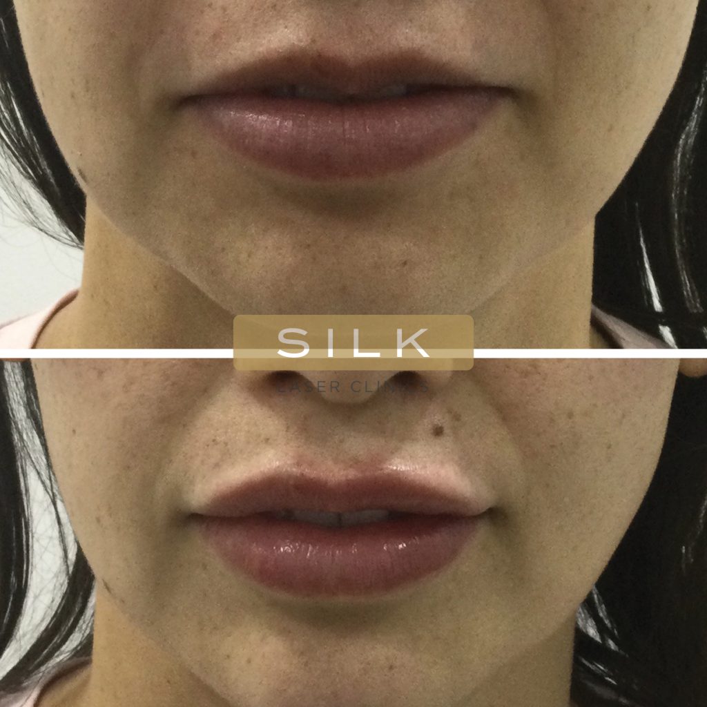 Lips-Treatment