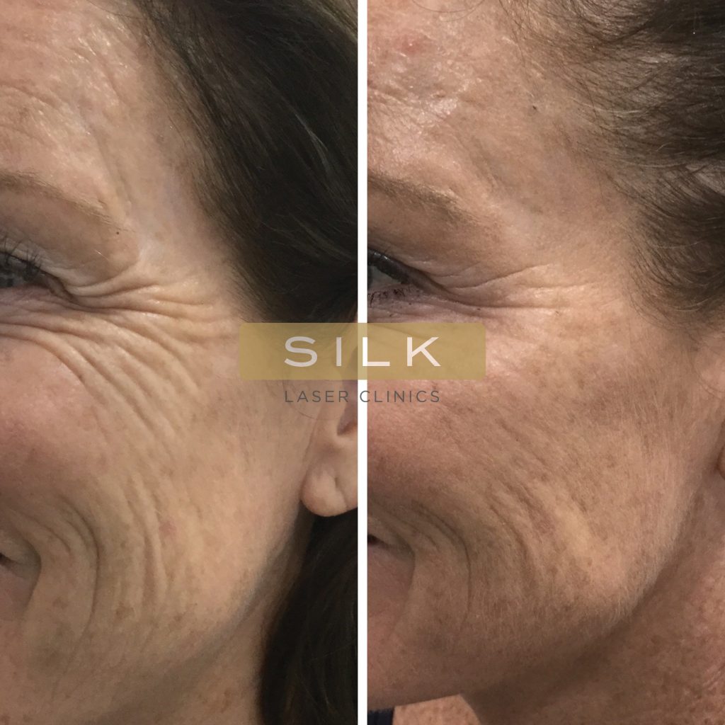 Anti-Wrinkle-Dermal-Filler