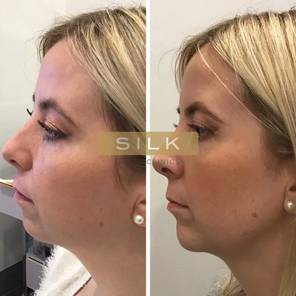 Temple dermal filler before and after images sydney clinic