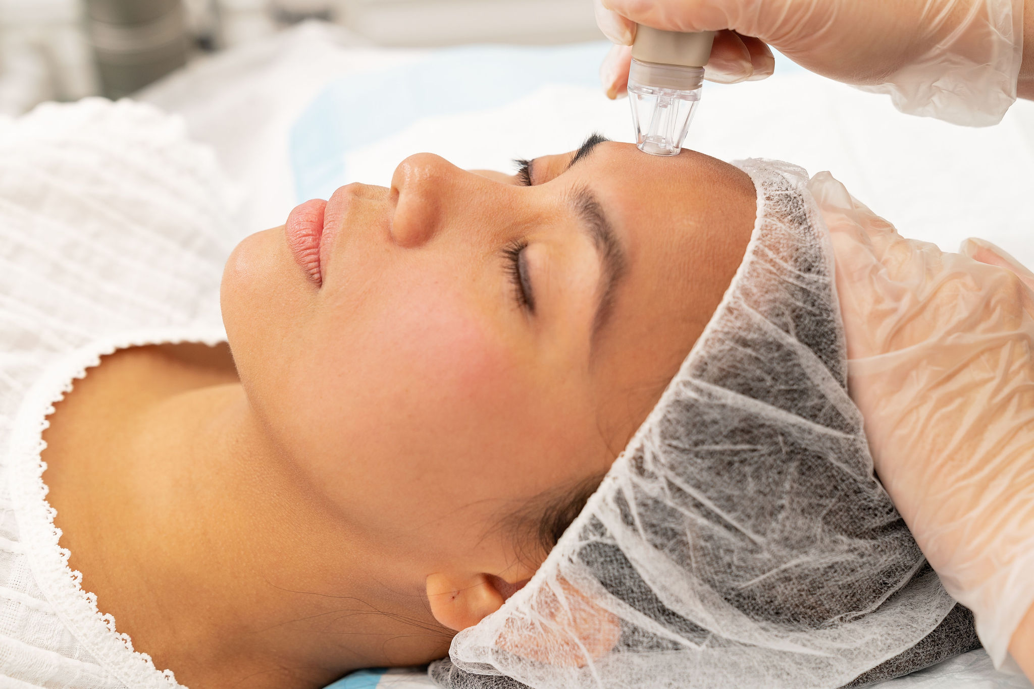 Microdermabrasion