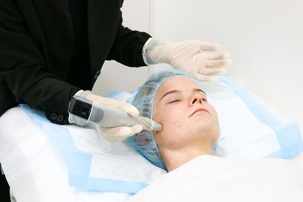 Microneedling