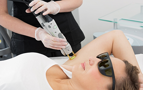 laser-hair-removal