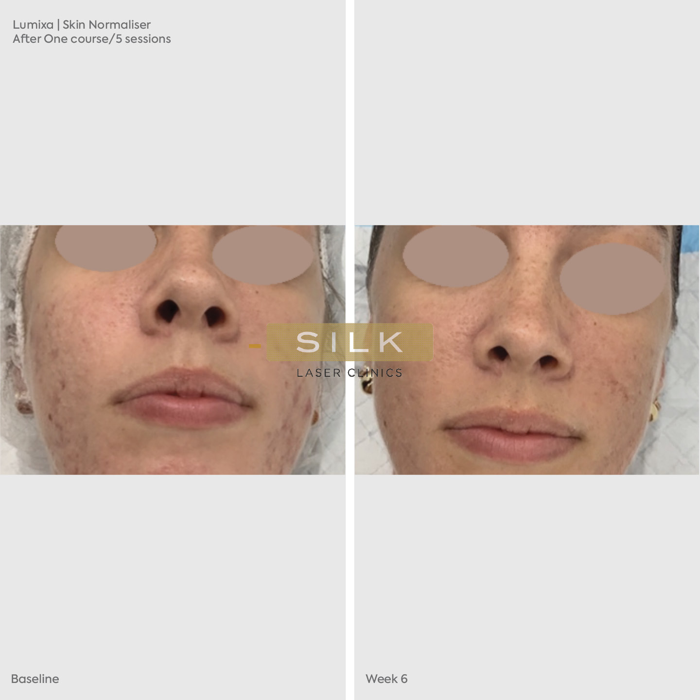 Lumixa Skin Treatment & Normaliser - SILK Laser Clinics