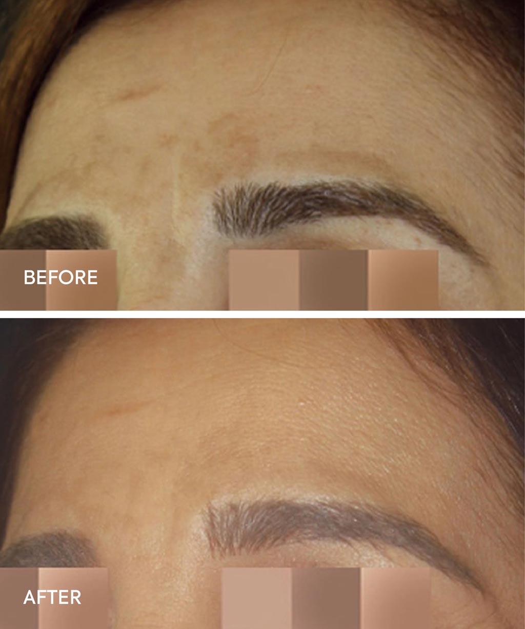 Cosmelan Treatment before and after images - 1