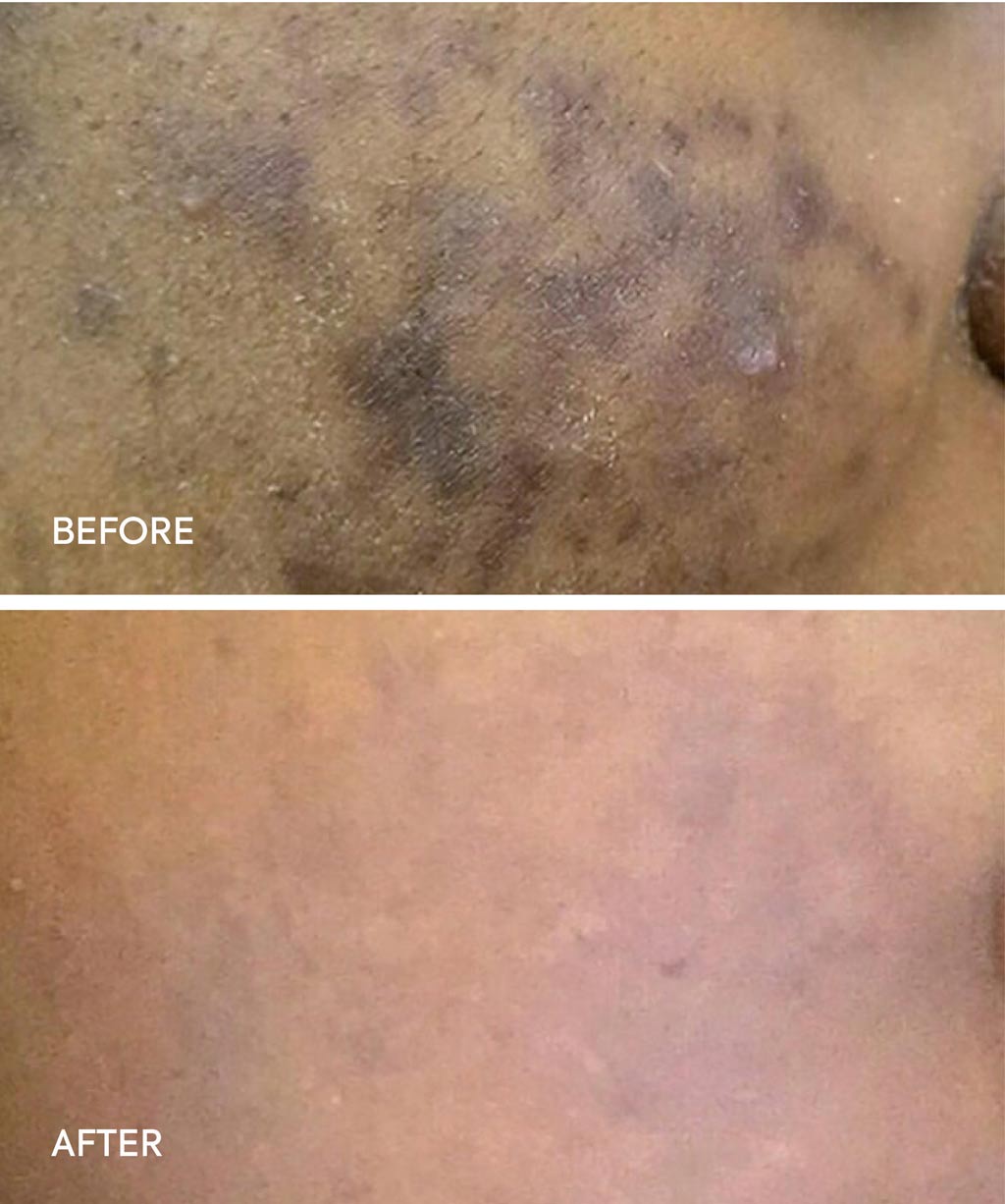 Cosmelan Treatment before and after images - 2