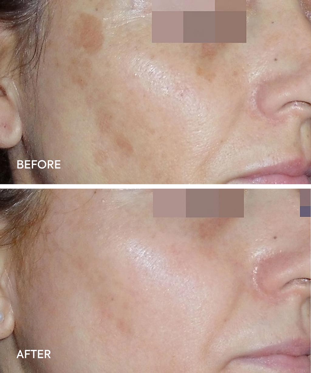 Cosmelan Treatment before and after images - 4