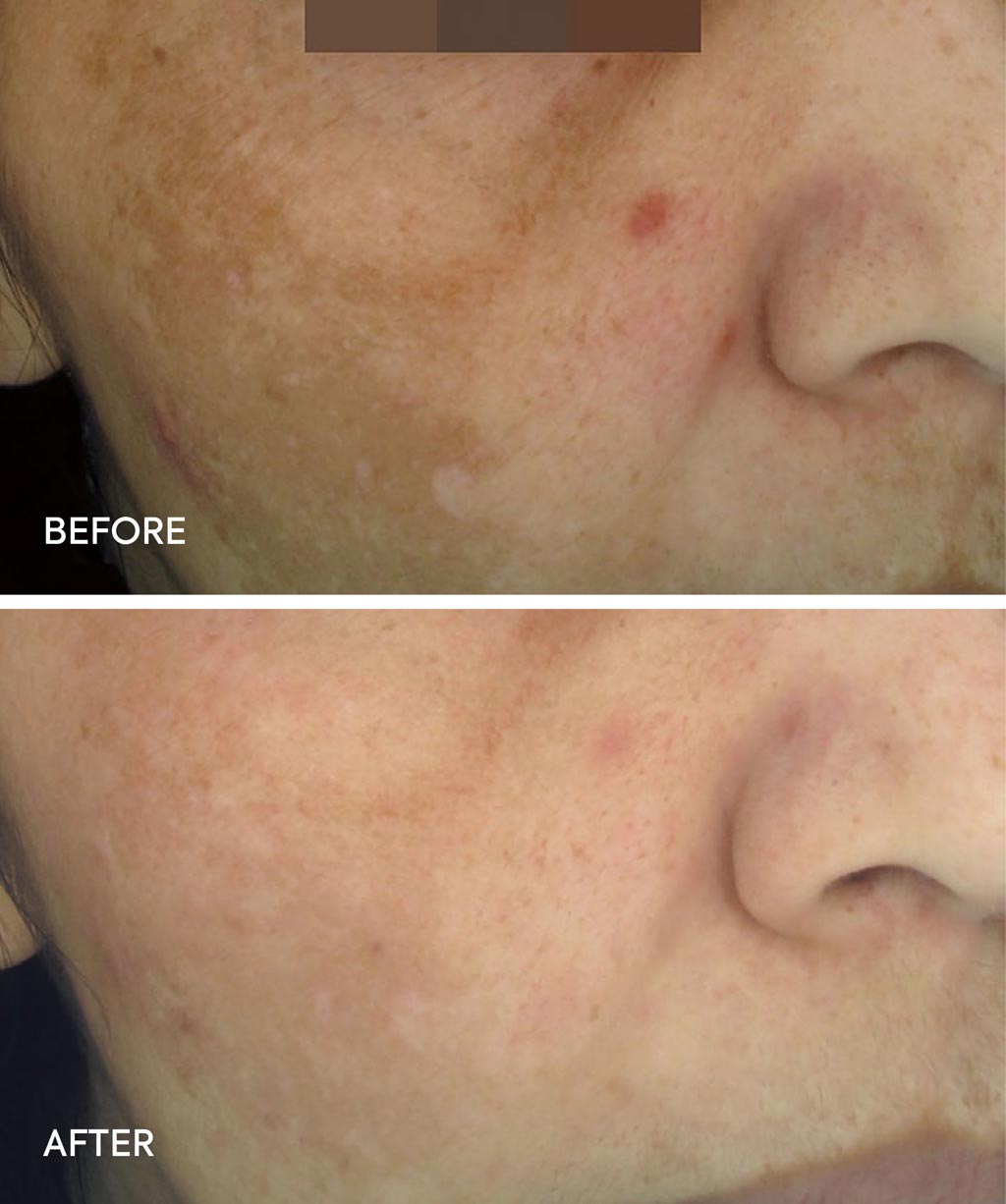 Cosmelan Treatment before and after images - 5