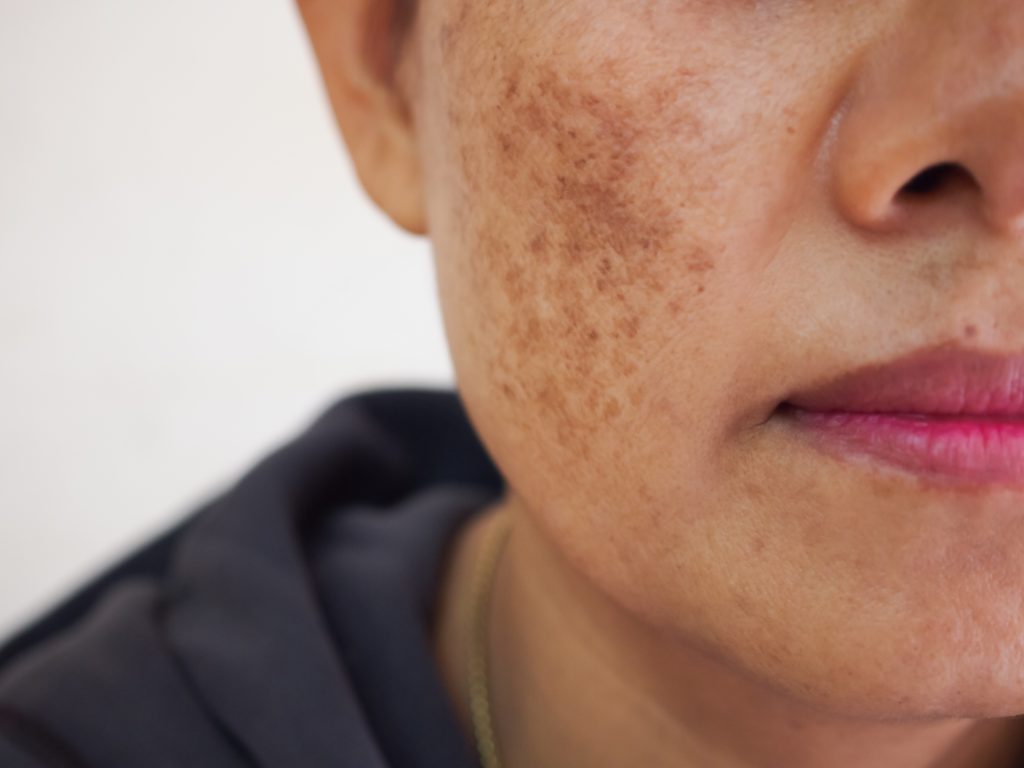 What is hyperpigmentation and how can I treat it? - SILK Laser Clinics