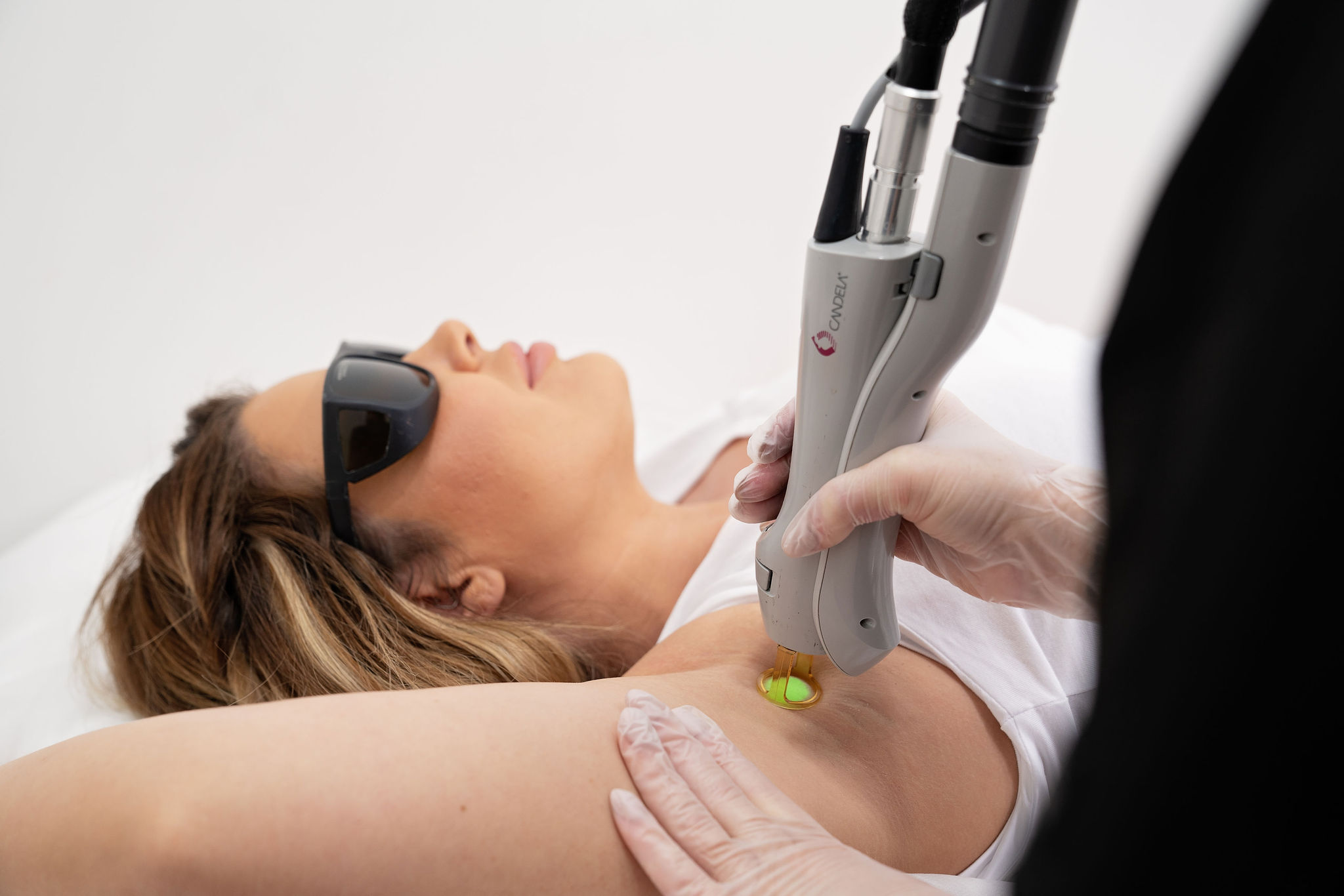 laser hair removal on underarms